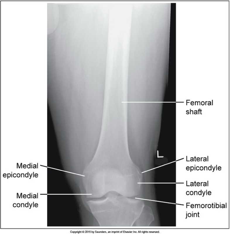 <p>AP femur</p>