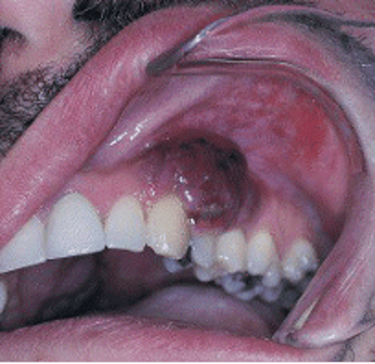 <p><br><span>Cancer caused by the human herpes virus 8 (HHV-8) that mainly affects the skin and mucous membranes but may also cause extensive visceral organ involvement; also called malignant neoplasm of soft tissue</span></p>