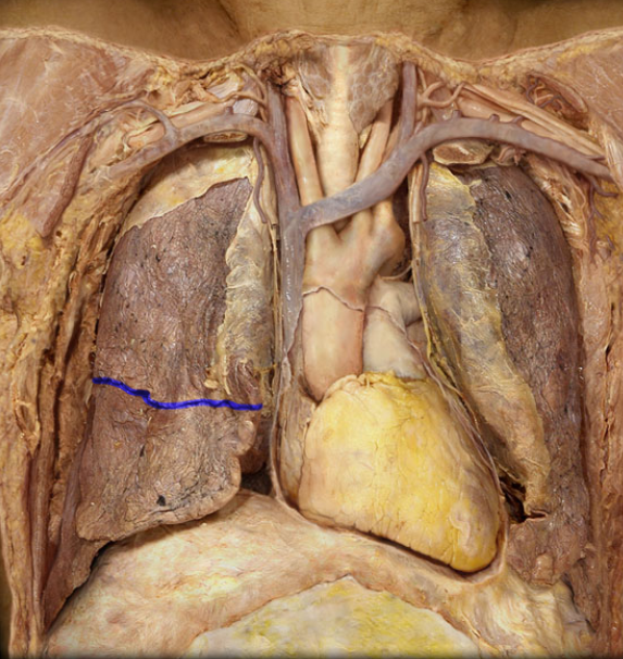 <p>remember only on right lung</p>