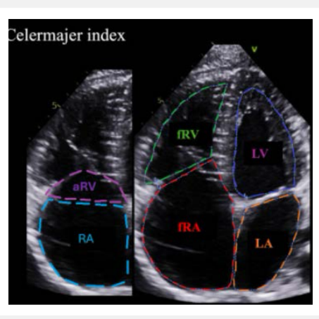 <p>The atrialized right ventricle is the inlet portion of the RV located between the <strong>true tricuspid annulus</strong> and the <strong>functional annulus</strong>.</p>