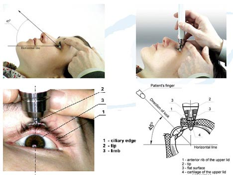 <ul><li><p><span style="background-color: transparent; font-family: "Times New Roman", serif;">Device to measure Intraocular Pressure</span></p></li></ul><p></p>