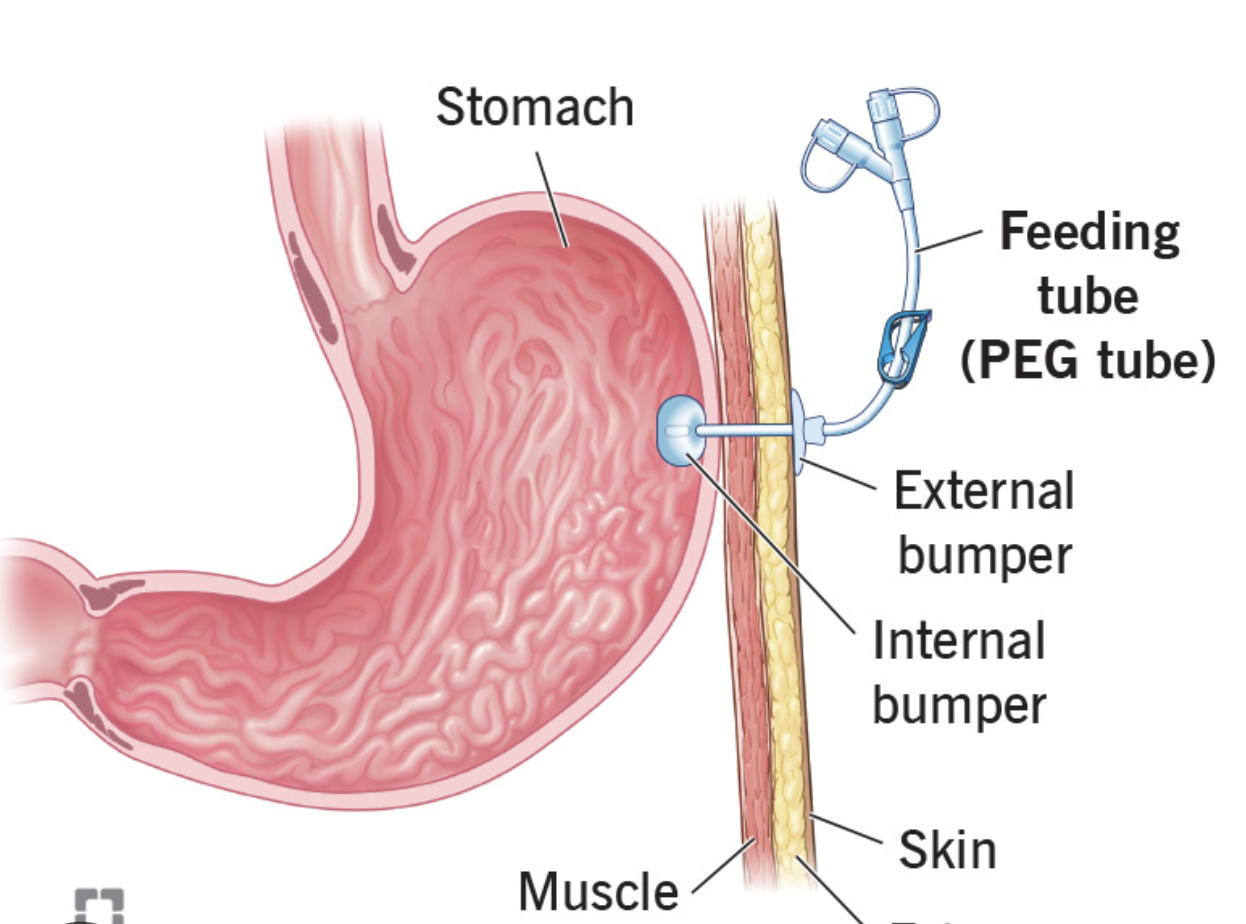 <p>A specific method used to insert a G-tube, requiring a shorter tube and placed with an endoscope</p>