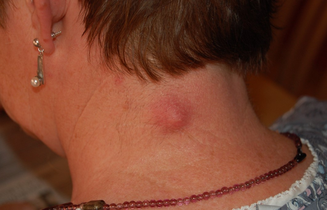 <p>epidermal inclusion cysts*</p><ul><li><p>definition</p></li><li><p>contains what</p></li></ul><p></p>