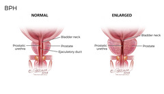 <p>benign prostatic hypertrophy</p>