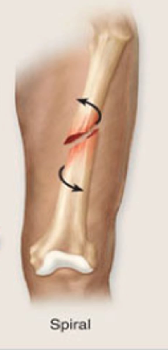 <p>bone is twisted</p>