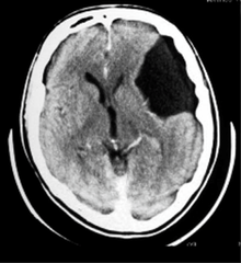 <p>benign cysts within the brain that do not communicate with the ventricular system</p>