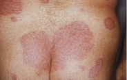 <p><mark data-color="yellow" style="background-color: yellow; color: inherit;">Immune disorder causing chronic inflamm of skin </mark></p><ul><li><p><span style="color: red;">skin cell produc. </span><strong>> </strong><span style="color: blue;">shedding</span> → epidermal thickness </p></li></ul><p><strong><mark data-color="blue" style="background-color: blue; color: inherit;">Signs:</mark></strong> occur anywhere → elbows, knees, palms, soles, scalp</p><ul><li><p><span style="color: red;">thick, raised red patches</span> w/ silvery flaking scales</p></li><li><p>painful &amp; itchy </p></li></ul><p><strong><mark data-color="red" style="background-color: red; color: inherit;">Lab:</mark></strong> based on signs</p><ul><li><p><span style="color: blue;">elevated CRP &amp; ESR </span>(serum inflamm markers)</p></li></ul><p><strong><mark data-color="purple" style="background-color: purple; color: inherit;">Tx:</mark></strong> no cure </p><ul><li><p>topicals/ointments (corticosteroid, retinoids), uv light therapy (kills cells), methotrexate </p></li></ul><p><strong><mark data-color="green" style="background-color: green; color: inherit;">Care:</mark></strong></p><ul><li><p>pt are better in warmer climate → uv kills cells </p></li></ul><p></p>