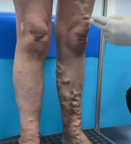 <p>Venas dilatadas y tortuosas causan problemas de circulación debido al mal funcionamiento de las válvulas</p>