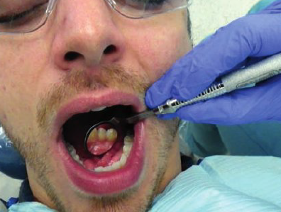 <ul><li><p>3 to 4 o’ clock position</p></li><li><p>Rest ring and pinkie on left side fo patient’s face near corner of mouth on premolar teeth</p></li><li><p>Use mirror head to push tongue away gently to expose lingual surface of anterior teeth in mirror</p></li></ul><p></p>