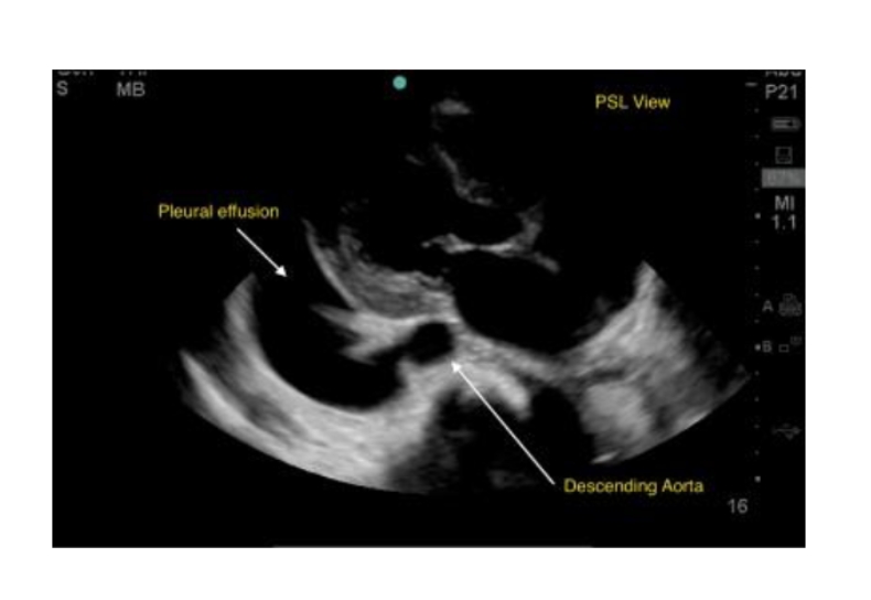 <p>Pleural Effusion </p>