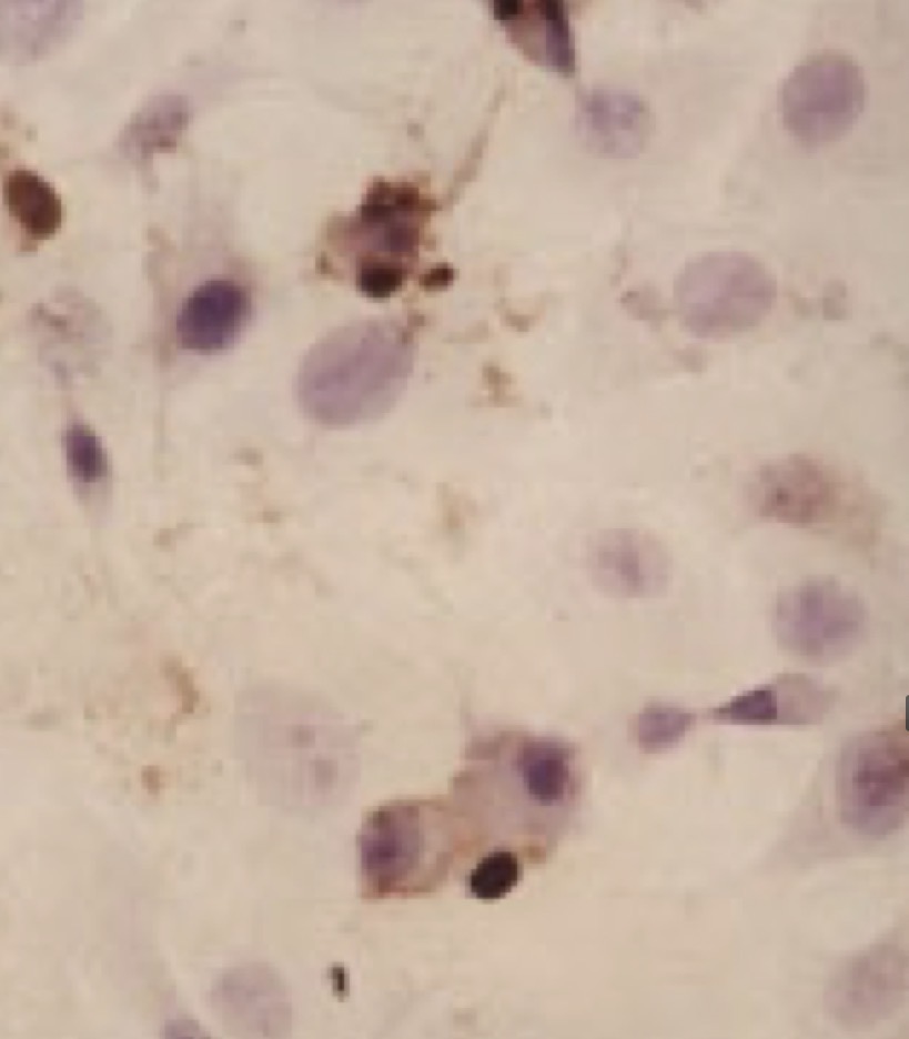 <p>Nucleus on neutrophil stains pale</p><ul><li><p>indicates rapid cell death</p></li><li><p>Highly toxic environment </p></li></ul><p></p>