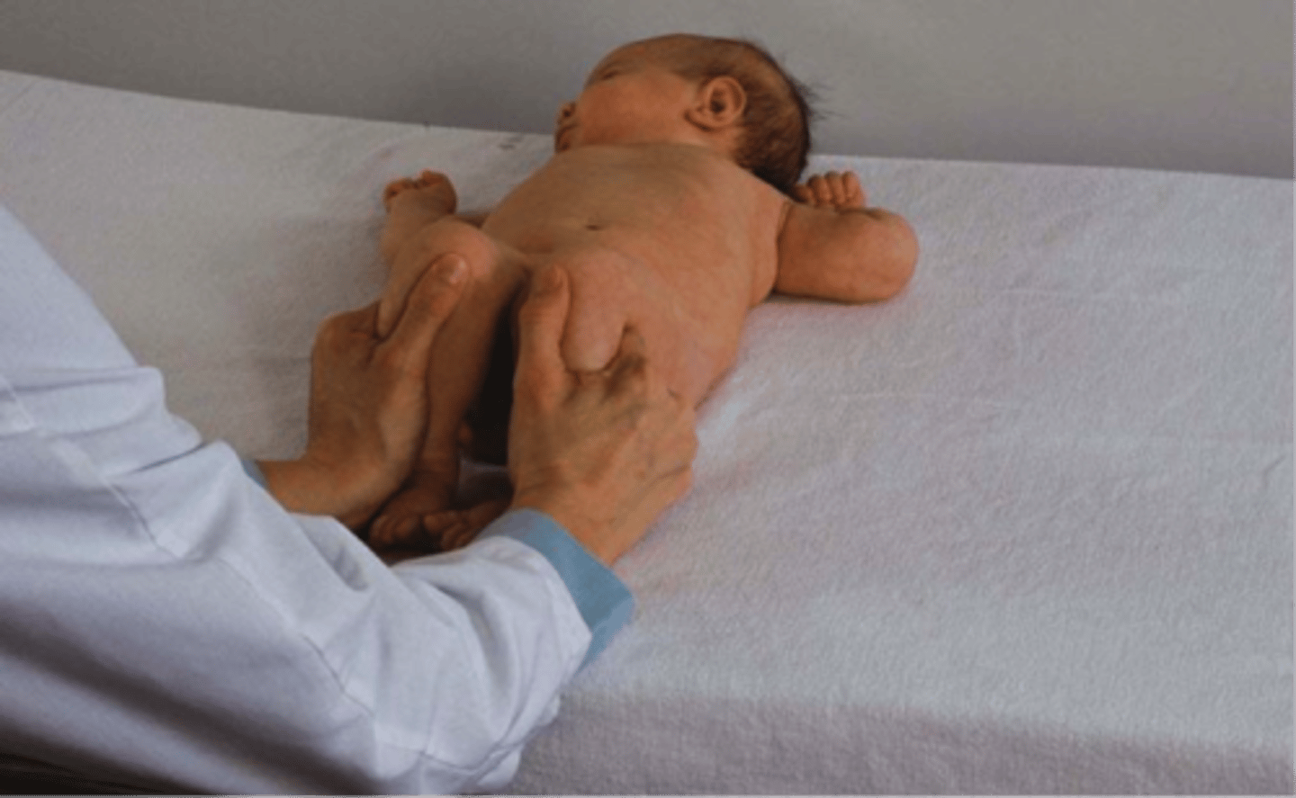 <p>infants, hip dislocation</p>