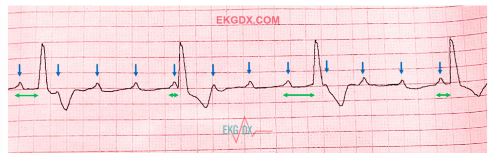 <p>Complete heart block can occur because the AV node and bundle of His have an abnormal location and an elongated conduction pathway.</p>