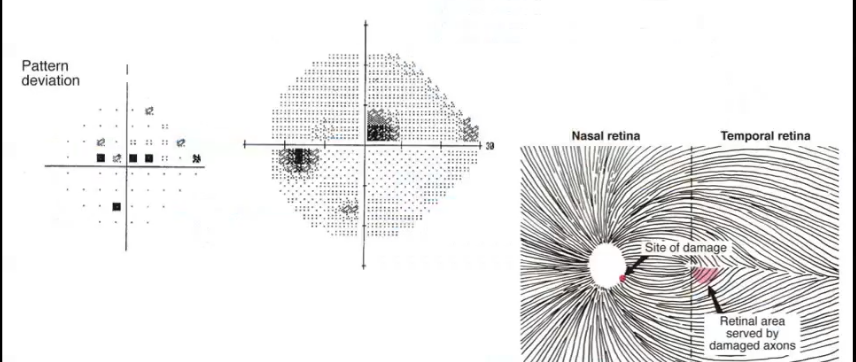 <p>paracentral defect </p>