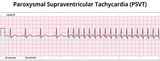 <p>Narrow-complex tachycardia with no discernable P waves, with rates typically 150-250 bpm </p><p>-Presentation: patient of any age with sudden onset of palpitations and lightheadedness, hemodynamically stable </p><p>-Tx: stable can be treated with vagal maneuvers then IV adenosine 6 mg rapid push, cardioversion if unstable, long term can be managed with AV nodal blockers like CCBs and beta blockers, catheter ablation if symptomatic </p>