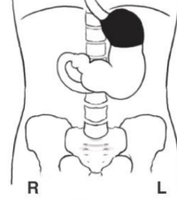 <p>What position is the patient in? Air = black. Barium = white</p>