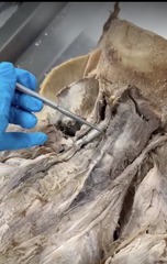 <p>Name the muscle</p><p>- middle layer</p><p>- most medial capitis of spinalis and semispinalis</p>