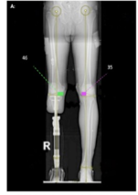 <p>osseointegration (OI)</p>