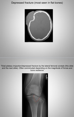 <p>Depression fracture</p>
