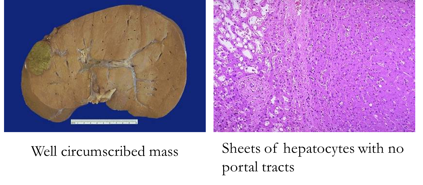 <p>in women of childbearing age</p><p>assoc with oral contraceptive use, regresses w/d/c of hormones</p>