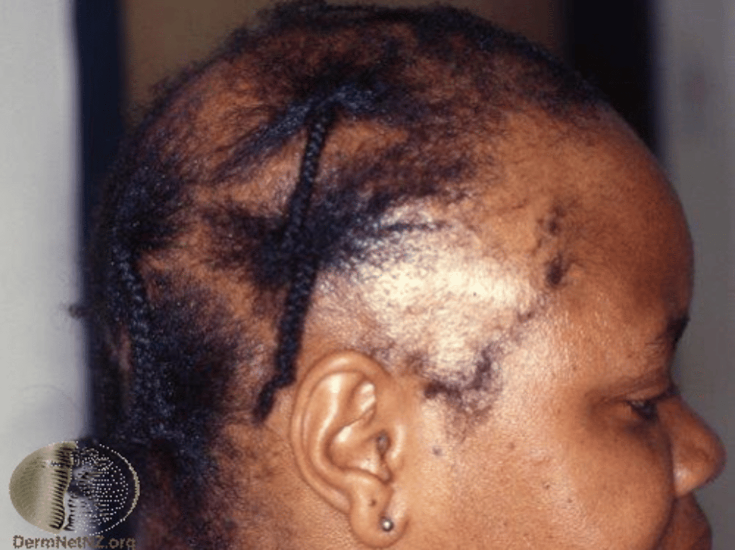 <p>often hereditary, hormone changes, chemotherapy, stress, burns, fungal skin infections</p>