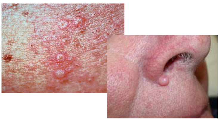 <p>PAPULE</p><p>small, ______ lesion</p>