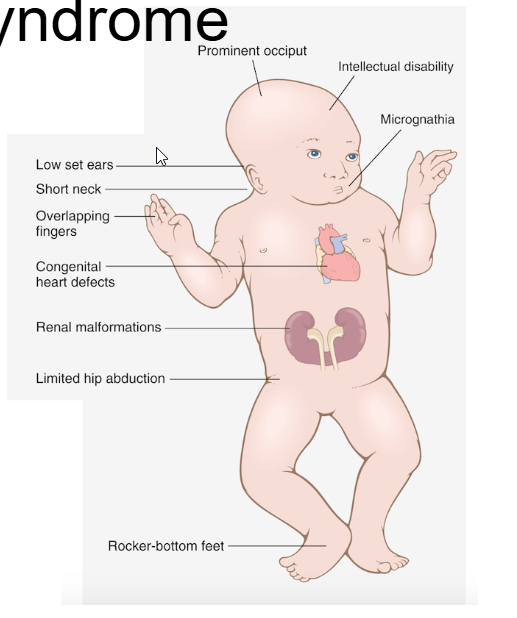 <p><span style="background-color: transparent;">Trisomy 18: Edwards Syndrome Symptoms</span></p><ul><li><p><span style="background-color: transparent;">Growth + structure failure -> Heart/Limbs malformation </span></p><ul><li><p><span style="background-color: transparent;">Growth restriction</span></p></li><li><p><span style="background-color: transparent;">Clenched fists</span></p></li><li><p><span style="background-color: transparent;">Rocker-bottom feet</span></p></li></ul></li></ul><p></p>