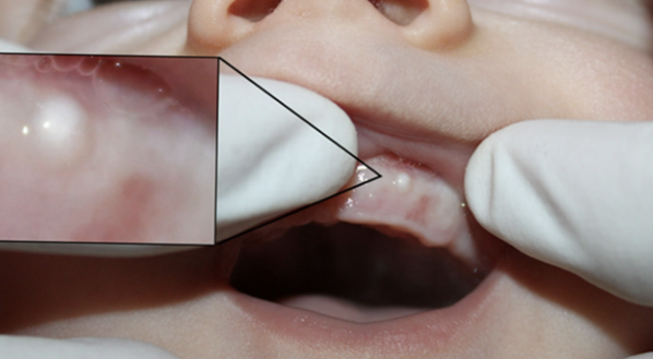 <p>Cyst of Newborn: occur along the buccal and lingual aspects of the alveolar ridge </p>