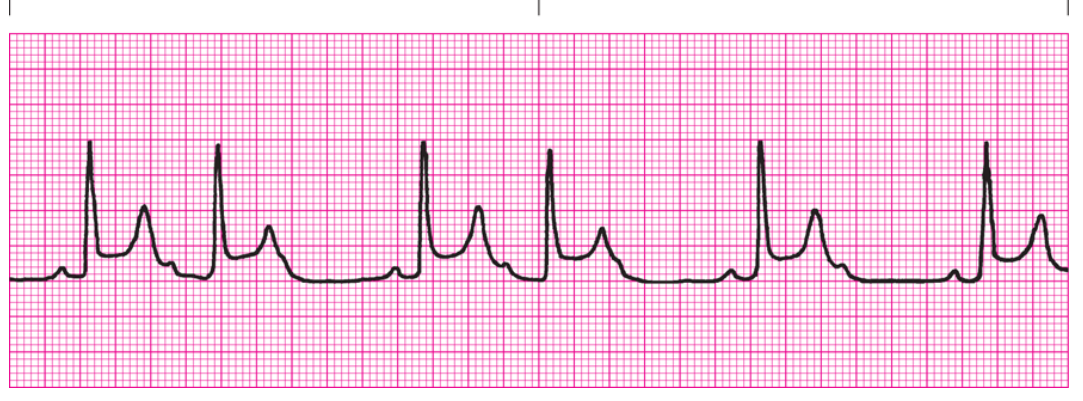 <ol><li><p>Regularity?</p></li><li><p>Rate</p></li><li><p>P Waves</p></li><li><p>PRI</p></li><li><p>QRS</p></li><li><p>Interpretation</p></li></ol><p></p>