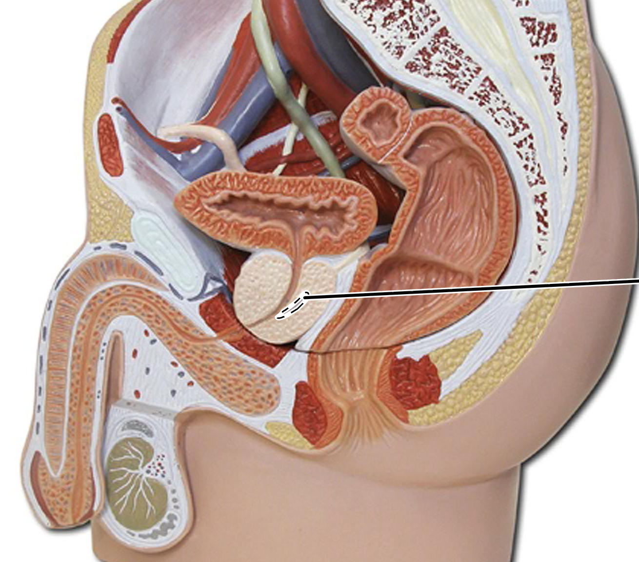 <p>(inside the prostate gland)</p>