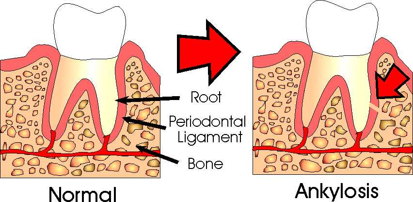 <p>ankylosis</p>