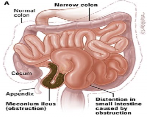 <ul><li><p>small-bowel disorder with thick meconium in distal ileum</p></li><li><p>ileum dilates because of impacted meconium</p></li><li><p>most infants with this have <span style="color: red;">cystic fibrosis </span></p></li></ul><p></p>