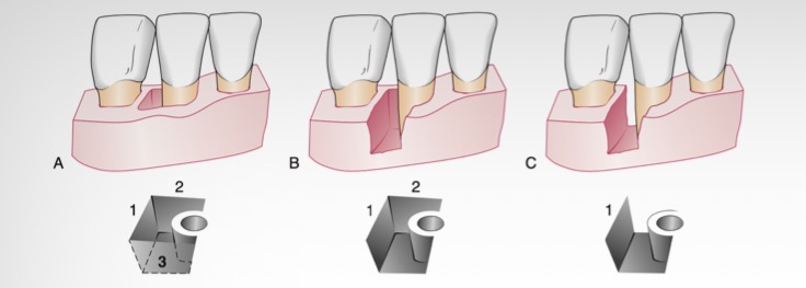<p>bone profile lies obliquely to root profile leaving undermined groove along root, esp interdentally </p><p>Depend on number of bony walls</p><ul><li><p>3 wall, 2 or 1</p></li></ul><p></p>