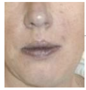 <p>Blue skin, sign of decreased oxygen </p>