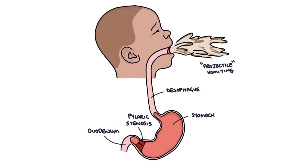 <p>Manifestations of pyloric stenosis</p>