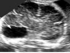 <p>benign cyst in the cerebrospinal axis </p><ul><li><p>do not communicate with ventricular system</p></li></ul><p></p>