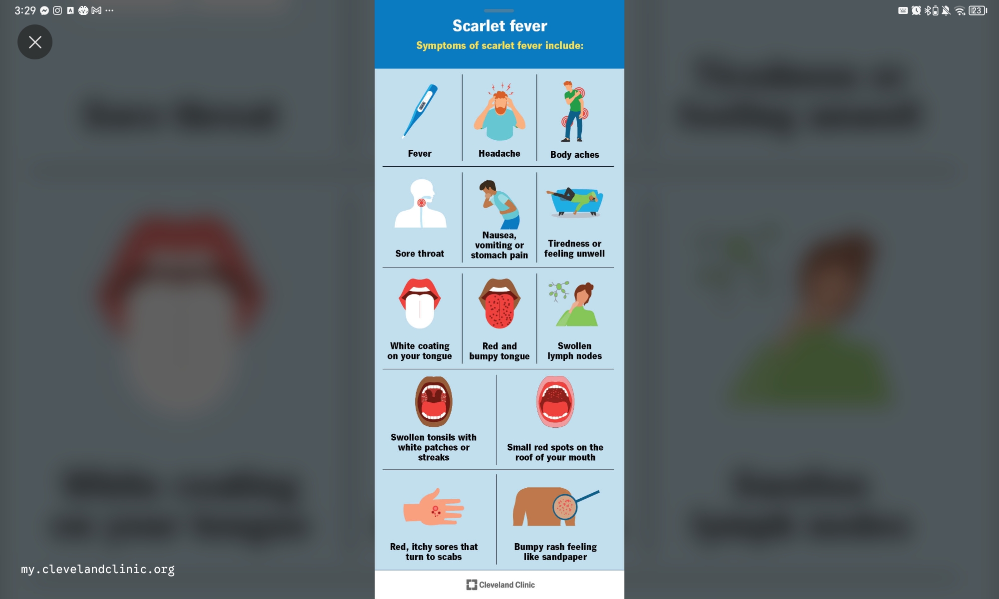 <p>Answer: A. Otitis media</p><p>Rationale:</p><p>A. Otitis media – <span data-name="check_mark_button" data-type="emoji">✅</span> S. pneumoniae is a major bacterial cause of acute otitis media.</p><p>B. Scarlet fever – <span data-name="cross_mark" data-type="emoji">❌</span> Caused by GAS.</p><p>C. Rheumatic fever – <span data-name="cross_mark" data-type="emoji">❌</span> Post-GAS complication.</p><p>D. Diphtheria – <span data-name="cross_mark" data-type="emoji">❌</span> Caused by C. diphtheriae.</p><p>E. Tetanus – <span data-name="cross_mark" data-type="emoji">❌</span> Caused by C. tetani.</p>