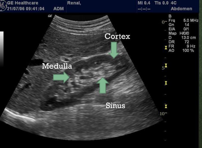 <p>What is the cortex?<br>→ Outermost zone of the kidney</p><p>What does the cortex contain?<br>→ carries Convoluted tubules</p><p>Is the cortex hypoechoic or hyperechoic?<br>→ Hypoechoic</p><p>What type of echoes are seen in the cortex?</p><p>→ Low-level grey echoes</p><p>Convoluted tubules = tiny twisted kidney tubes that help filter blood and make urine.</p>