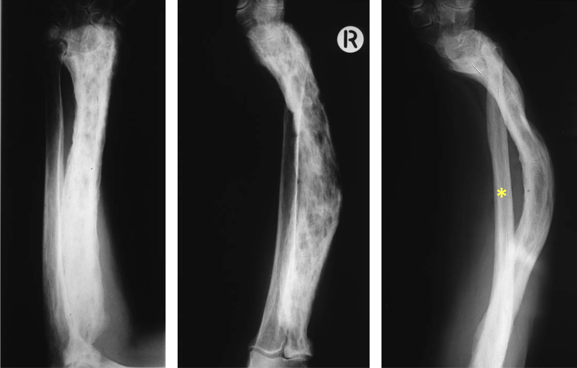 <p>What tumour like disorder is this, and what can be seen in each image?</p>