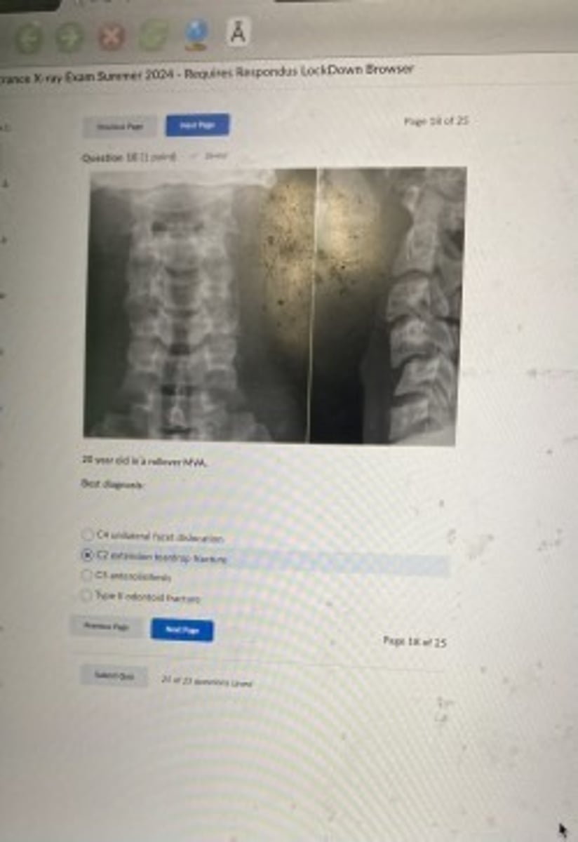 <p>C4 unilateral facet dislocation</p>