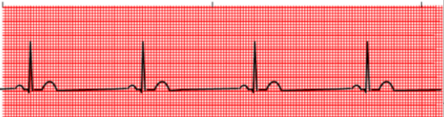 <p>how did you know this was sinus bradycardia</p>