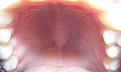 <p>This lesion is</p>