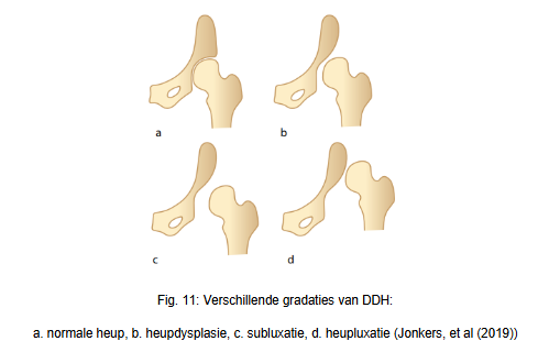 <p>Developmental dysplasia of the hip, het is een verzamelnaam en spectrum voor verschillende soorten dysplasie en (sub-)luxatie van de heup.</p><p>Aangeboren heupafwijkingen komen 4x voor bij meisjes en 5x bij kinderen die in stuitligging geboren zijn. Een bij de geboorte lijkend normaal heupgewricht kan zich tijdens de adolescentie nog ontwikkelen tot dysplastische heup, vooral na stuitligging. Andere risicofactoren zijn DDH in de familie en het strak inbakeren van het onderlichaam met de heupen en knieën gesterkt.  </p><p>DDH is een risicofactor voor het ontwikkelen van chronische pijn, loopproblemen en vroegtijdige slijtage met soms als gevolg een totale heupprothese op jonge leeftijd.</p><p>-Heupdysplasie → bij DDH is het heupgewricht niet goed ontwikkeld, de kom in de bekken is ondiep met vlakke randen waardoor de femurkop niet goed overdekt is. Hoe vlakker de randen, hoe groter het risico op luxatie. Ook de bouw van de proximale femur kan afwijken, vaak staan de femurkop-en hals veel verder naar voren ten opzichte van de knie dan normaal (=versterkte anteversie). De femurkop kan hierdoor minder stevig in de kom staan.</p><p>-Subluxatie van de heup → de femurkop staat op de rand van de kom en maakt dus wel nog gedeeltelijk contact met de kom.</p><p>-Heupluxatie → de heup maakt geen contact meer met de kom.</p><p>-Congenitale heupdysplasie → bij een te stijl acetabulum (heupkom) en/of een afwijkende femurkop spreekt men van congenitale heupdysplasie. Hierdoor passen de heupkop en kom niet goed in elkaar wat uiteindelijk het risico op vroegtijdige slijtage vergroot. Soms is het acetabulum zo ondiep dat de heupkop niet meer in de kom staat (=congenitale heupluxatie). Als hierbij ook versterkte anteversie is kan dit het contact met de al afwijkende femurkop en de ondiepe heupkom nog bemoeilijken. </p>