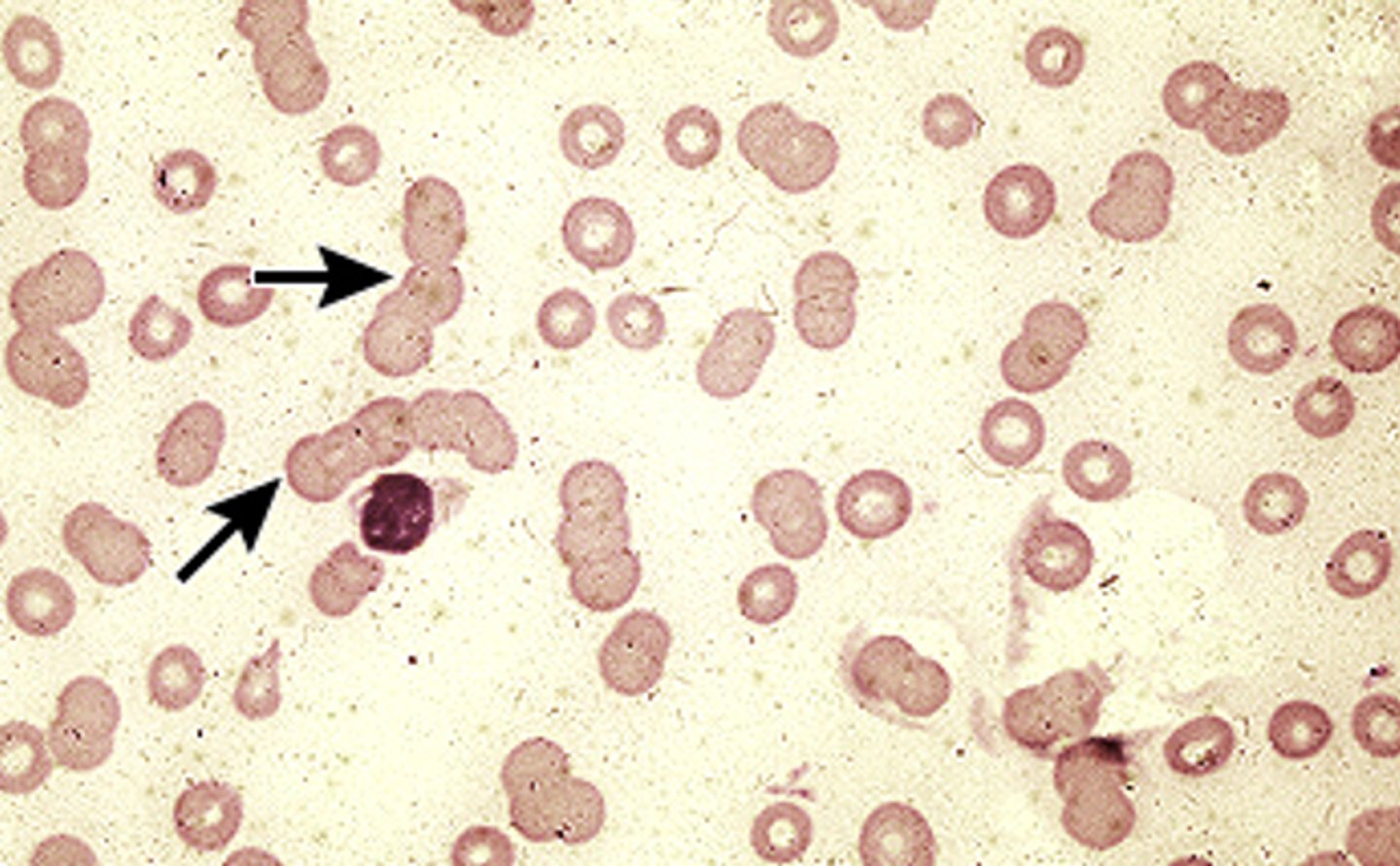 <p>Red blood cells clump together and form what looks like "stacks of coins"</p>