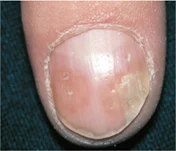 <p>Name this + its etiology</p>