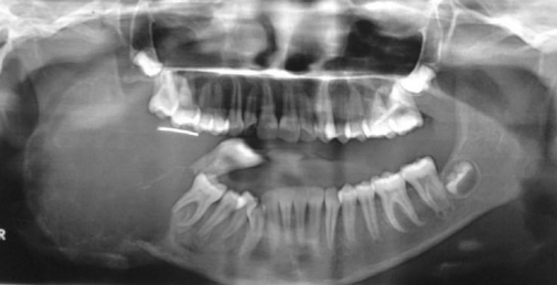 <p>A 18 year old boy presented with cystic swelling of mandible. Provide DD and justify</p>
