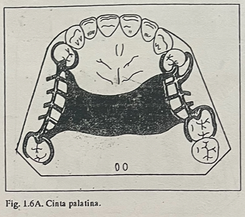 <p><span>● Clase III con brecha amplia.</span></p><p><span>● Clase I y II con buenos rebordes residuales o paladares en V o U con pilares fuertes</span></p>