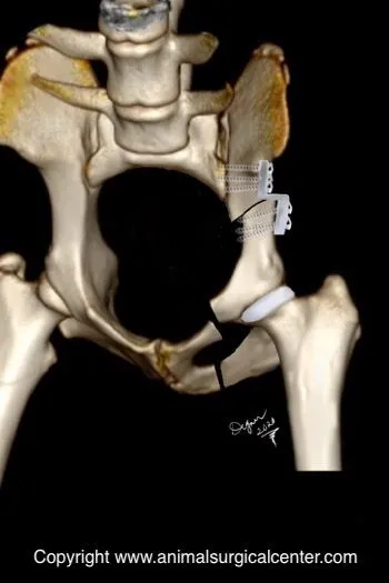 <p>Triple pelvic osteotomy</p>