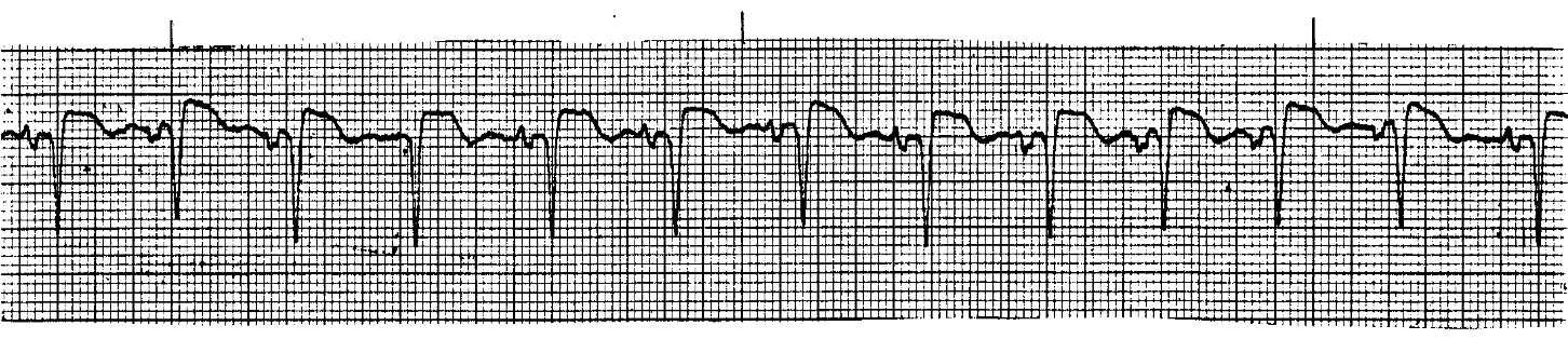 <p>What ECG is this? </p>