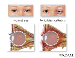 <p>Infection of the eyelid and surrounding tissue, more common in children but can also occur in adults</p>